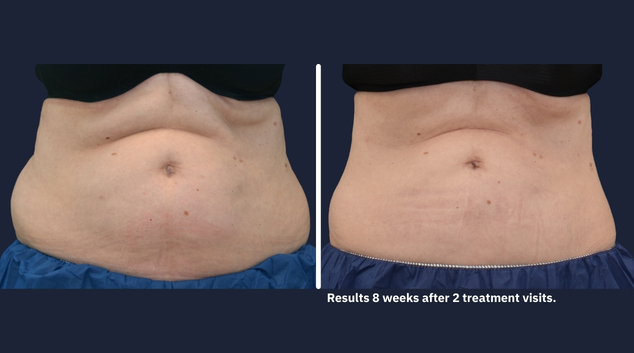 CoolSculpting Elite stomach before and after